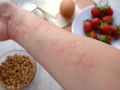 Qual é a diferença entre intolerância e alergia alimentar?