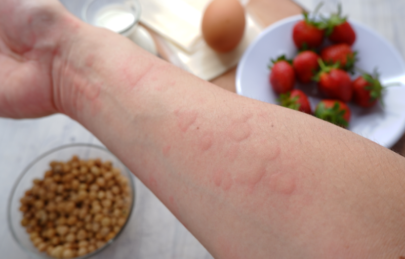 Qual é a diferença entre intolerância e alergia alimentar?