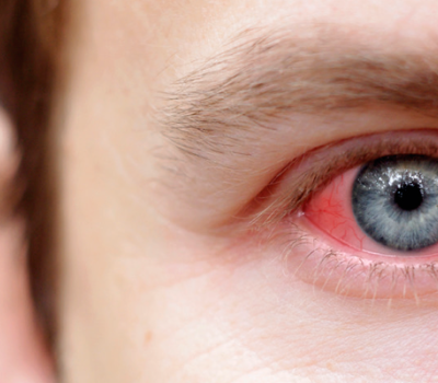 Conjuntivite alérgica 