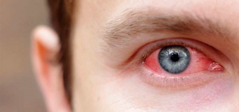 Conjuntivite alérgica 